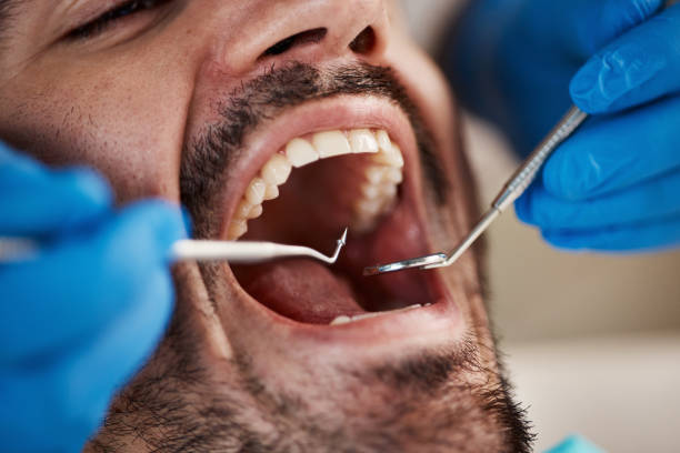 Best Emergency Dentist for Knocked-Out Tooth in South Fallsburg, NY